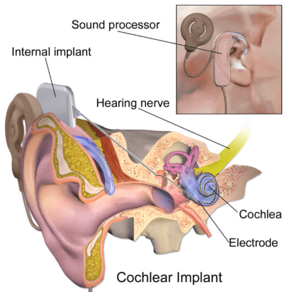 Diagram showing how a cochlear implant works, showing the external processor, internal implant, and electrodes in the cochlea